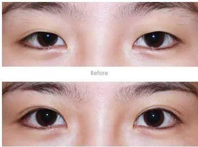 明星双眼皮,打造迷人眼眸的秘诀
